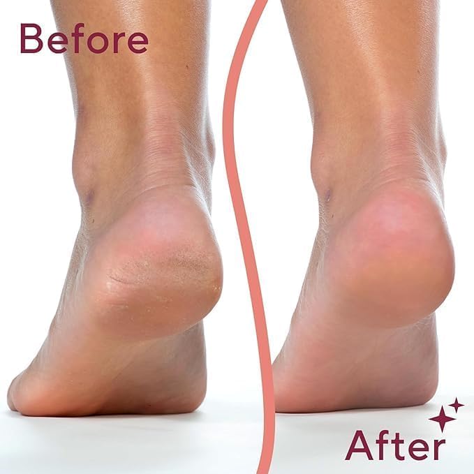 Electric Deadskin Remover For Feet (RA-068)