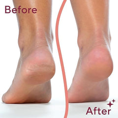 Electric Deadskin Remover For Feet